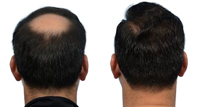 Hair Restoration Before & After Gallery - Patient 161404 - Image 1