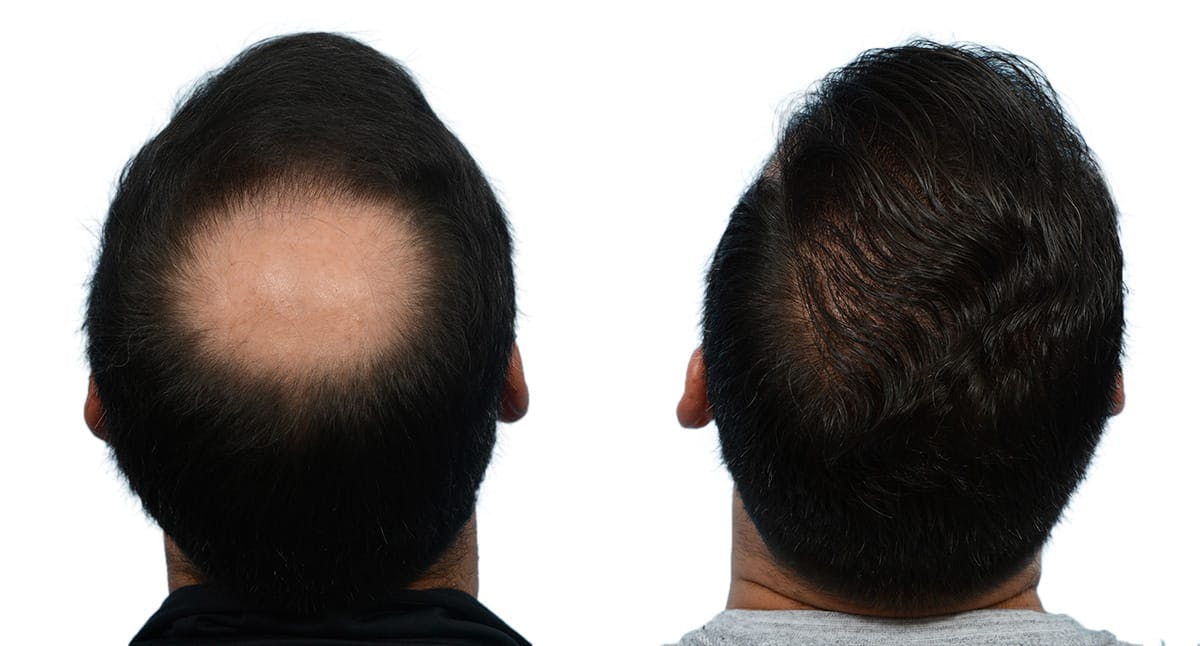Hair Restoration Before & After Gallery - Patient 161404 - Image 2