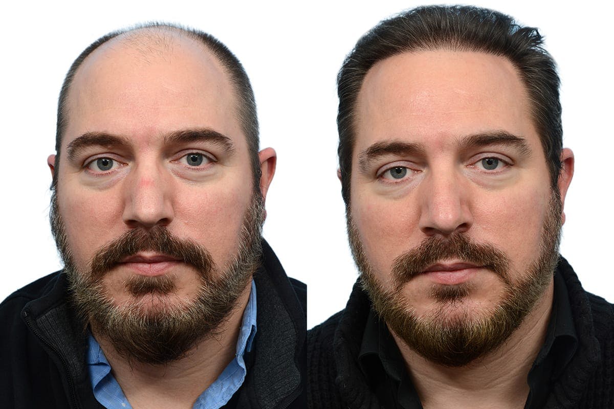 Hair Restoration Before & After Gallery - Patient 137264 - Image 1