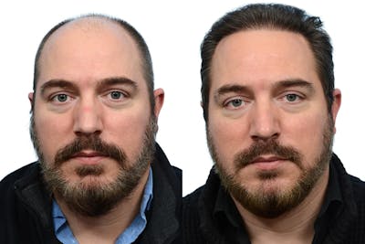 FUE Hair Transplant Before & After Gallery - Patient 103523 - Image 1