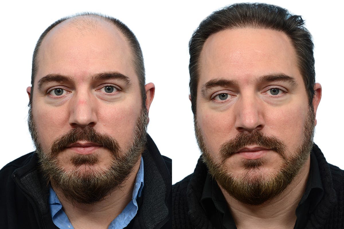 FUE Hair Transplant Before & After Gallery - Patient 103523 - Image 1