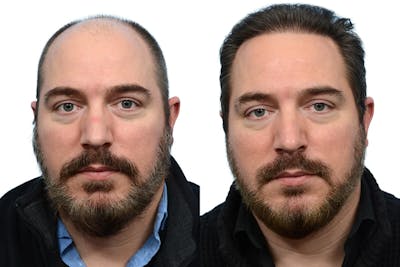 Hair Restoration Before & After Gallery - Patient 137264 - Image 1