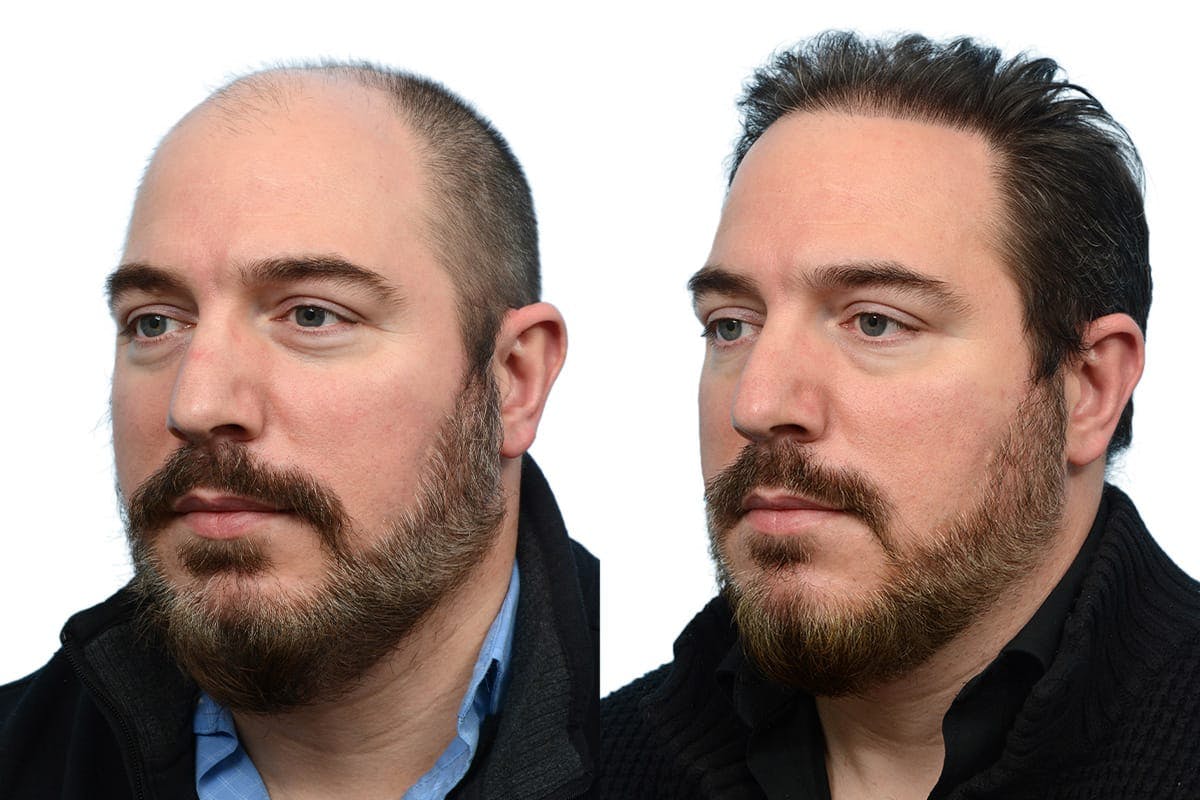 FUE Hair Transplant Before & After Gallery - Patient 103523 - Image 3