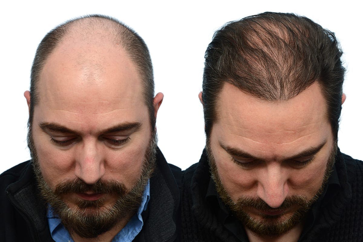 Hair Restoration Before & After Gallery - Patient 137264 - Image 4