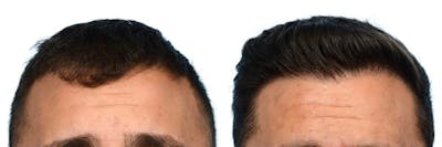 FUE Hair Transplant Before & After Gallery - Patient 411907 - Image 1