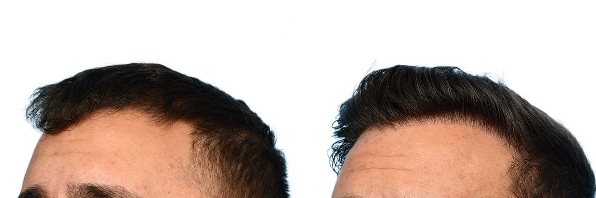 FUE Hair Transplant Before & After Gallery - Patient 411907 - Image 2