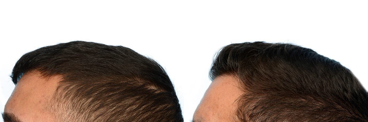FUE Hair Transplant Before & After Gallery - Patient 411907 - Image 3