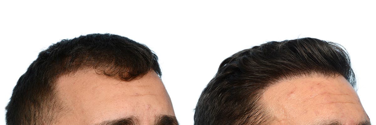 FUE Hair Transplant Before & After Gallery - Patient 411907 - Image 4