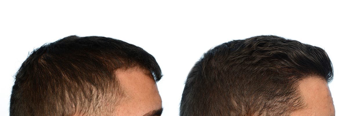 FUE Hair Transplant Before & After Gallery - Patient 411907 - Image 5