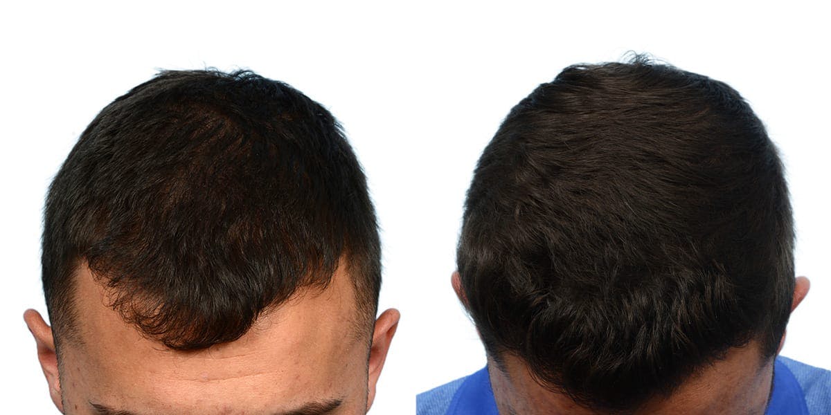 FUE Hair Transplant Before & After Gallery - Patient 411907 - Image 6