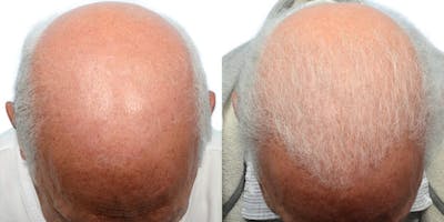 FUE Hair Transplant Before & After Gallery - Patient 182748 - Image 1