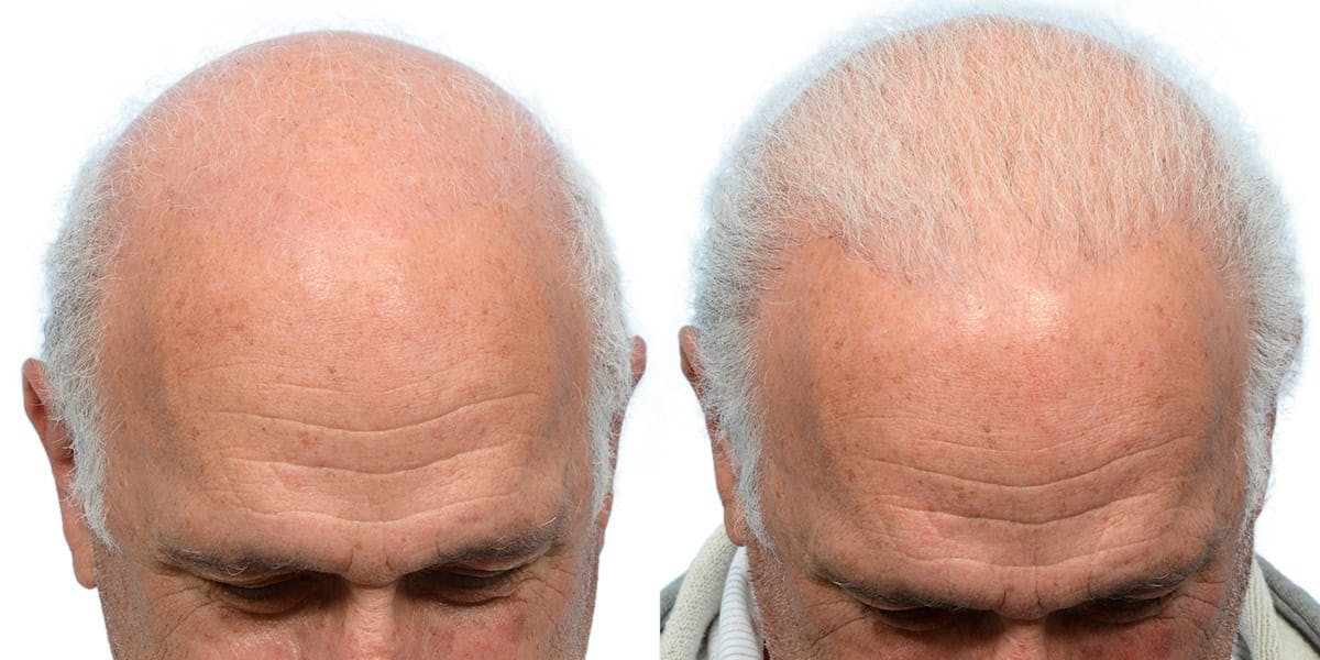 Hair Restoration Before & After Gallery - Patient 930447 - Image 2