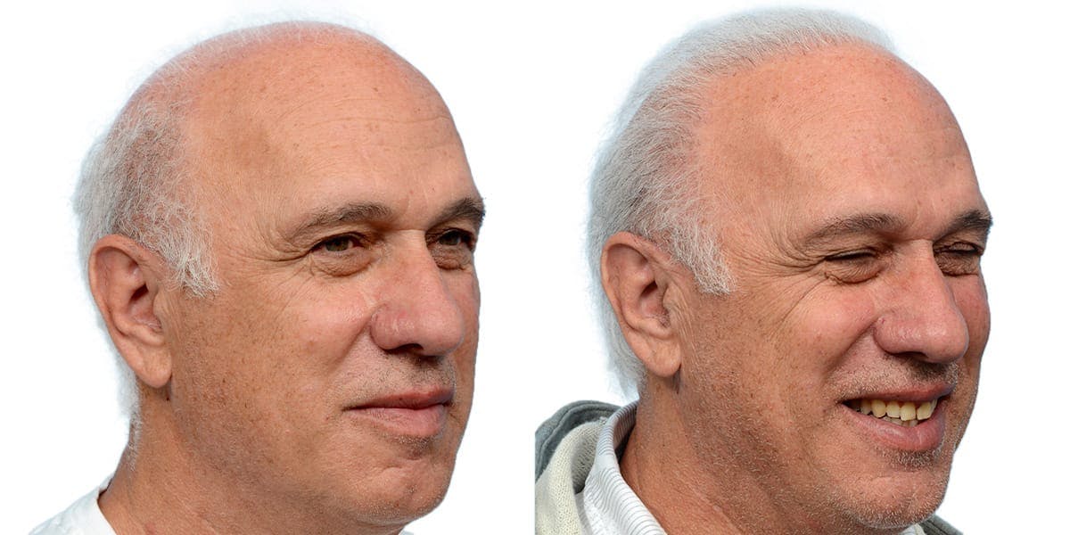 Hair Restoration Before & After Gallery - Patient 930447 - Image 3