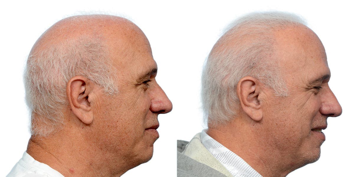 Hair Restoration Before & After Gallery - Patient 930447 - Image 4