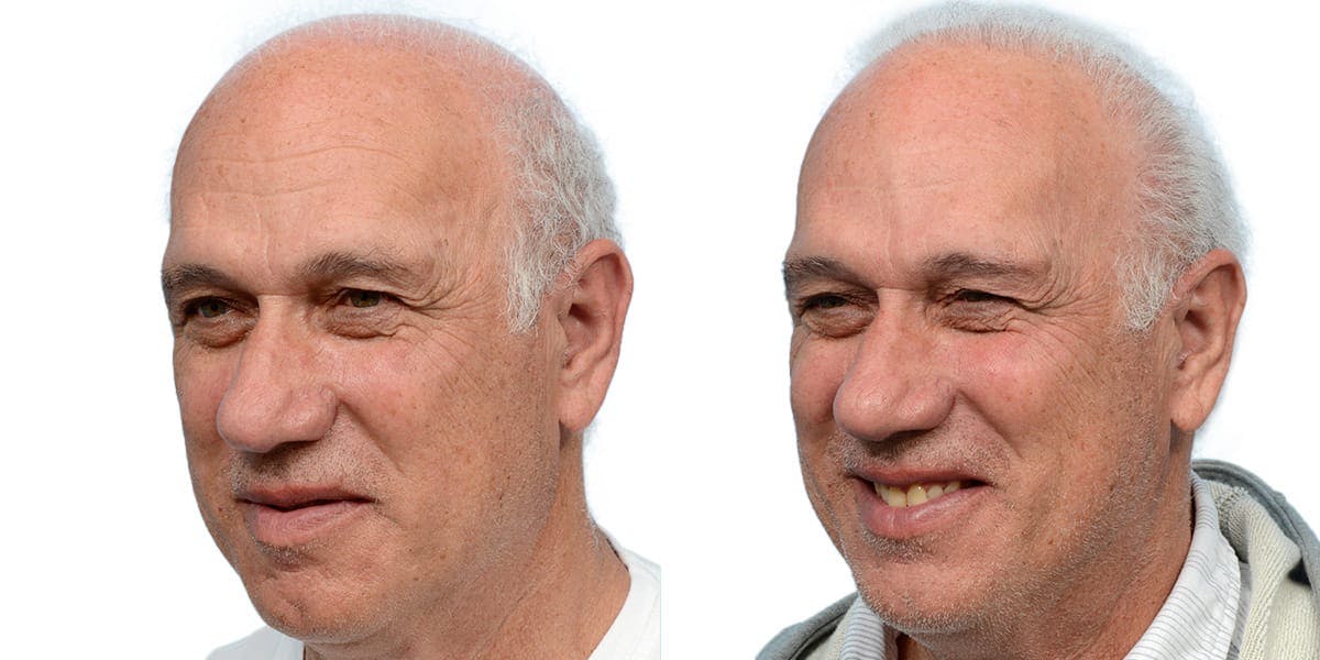 FUE Hair Transplant Before & After Gallery - Patient 182748 - Image 5