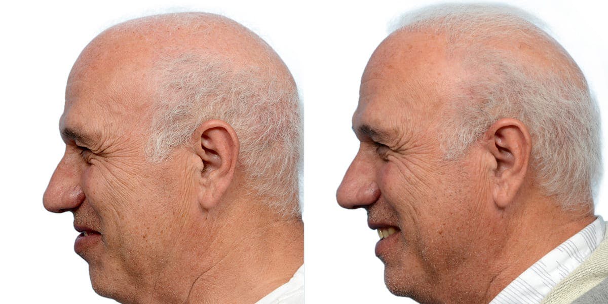 FUE Hair Transplant Before & After Gallery - Patient 182748 - Image 6
