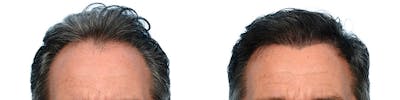 FUE Hair Transplant Before & After Gallery - Patient 219079 - Image 1