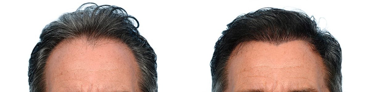 Hair Restoration Before & After Gallery - Patient 344776 - Image 1