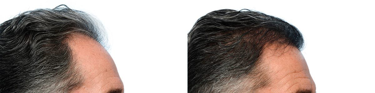 Hair Restoration Before & After Gallery - Patient 344776 - Image 2
