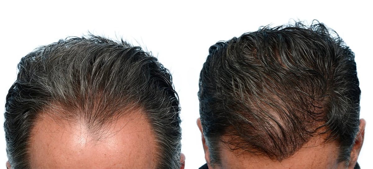 Hair Restoration Before & After Gallery - Patient 344776 - Image 4