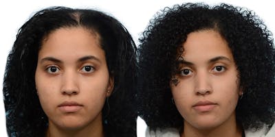Female Hair Restoration Before & After Gallery - Patient 133275 - Image 1