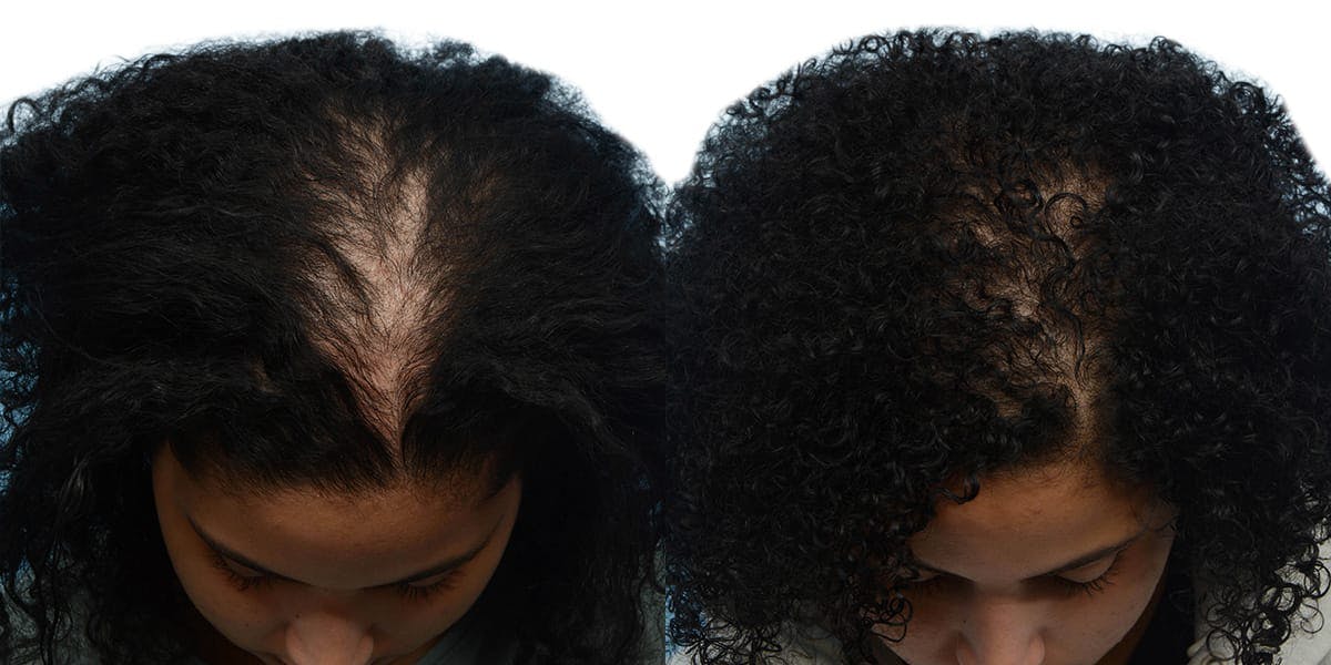 Female Hair Restoration Before & After Gallery - Patient 133275 - Image 2