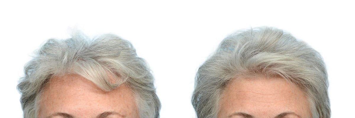 Platelet-Rich-Plasma Before & After Gallery - Patient 129427 - Image 1