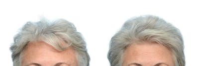 Hair Restoration Before & After Gallery - Patient 421085 - Image 1