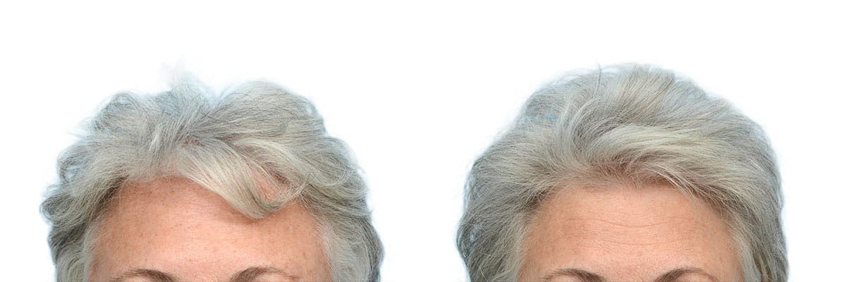 Female Hair Restoration Before & After Gallery - Patient 279669 - Image 1