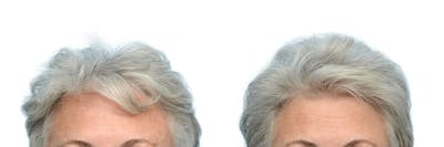 Platelet-Rich-Plasma Before & After Gallery - Patient 129427 - Image 1