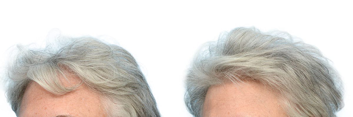 Hair Restoration Before & After Gallery - Patient 421085 - Image 2
