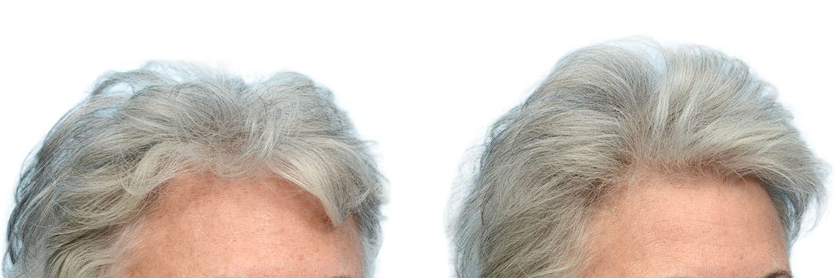 Female Hair Restoration Before & After Gallery - Patient 279669 - Image 3