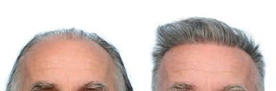 Hair Restoration Before & After Gallery - Patient 248146 - Image 1