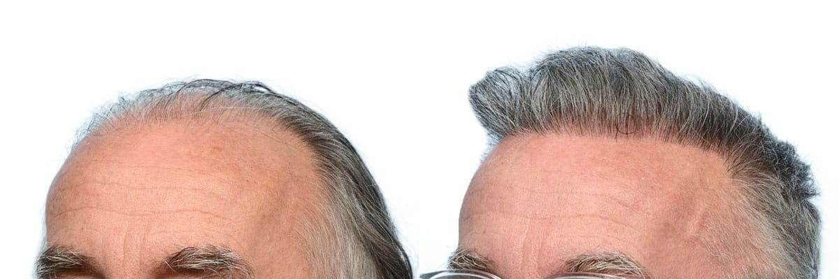 Hair Restoration Before & After Gallery - Patient 248146 - Image 2
