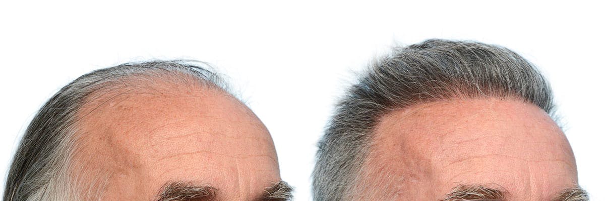Hair Restoration Before & After Gallery - Patient 248146 - Image 3