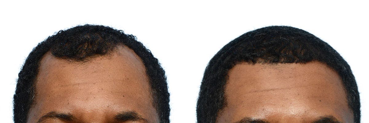 Hair Restoration Before & After Gallery - Patient 245501 - Image 1