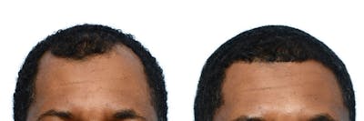 Hair Restoration Before & After Gallery - Patient 245501 - Image 1