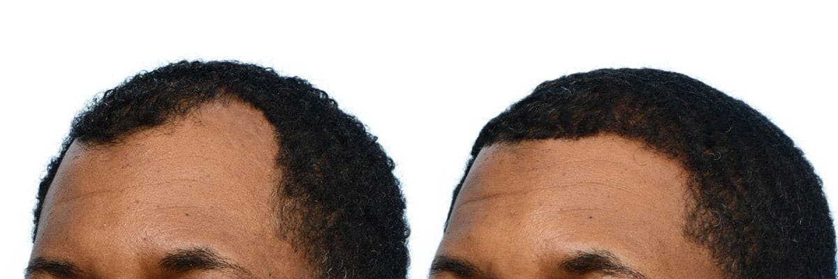 Hair Restoration Before & After Gallery - Patient 245501 - Image 2
