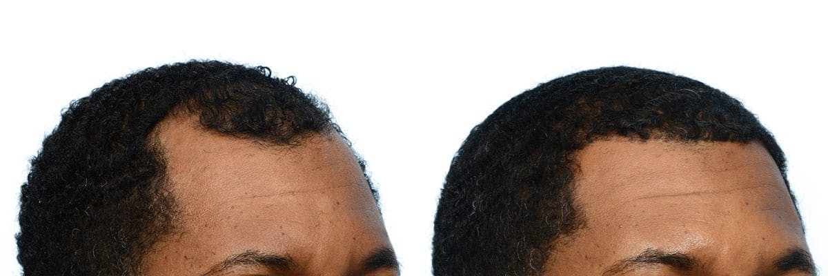 Hair Restoration Before & After Gallery - Patient 245501 - Image 3
