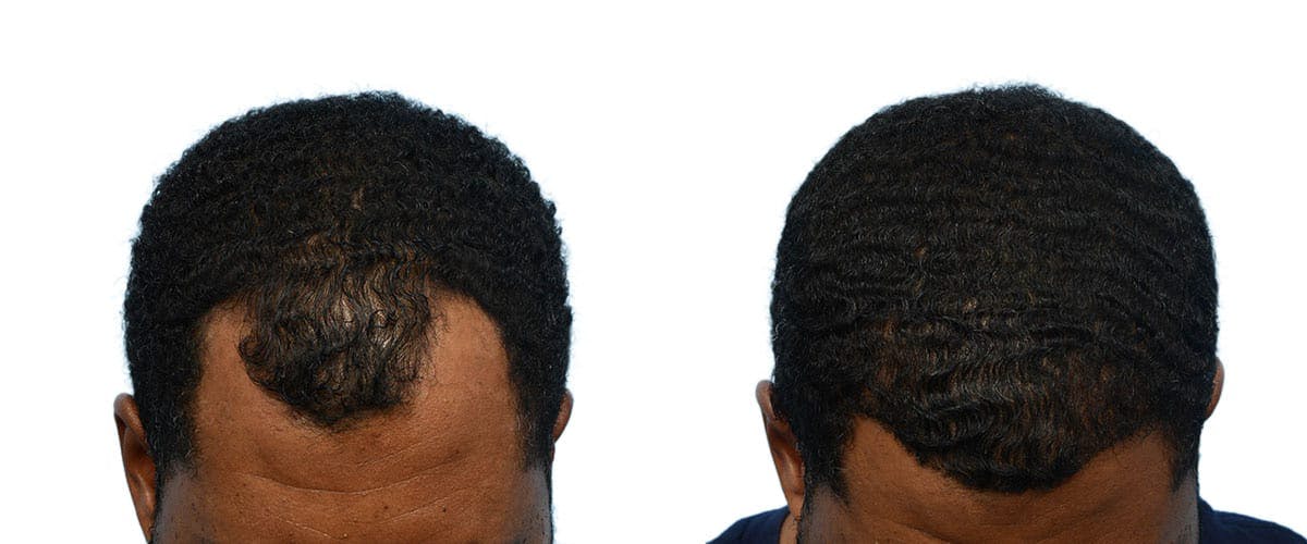 Hair Restoration Before & After Gallery - Patient 245501 - Image 4