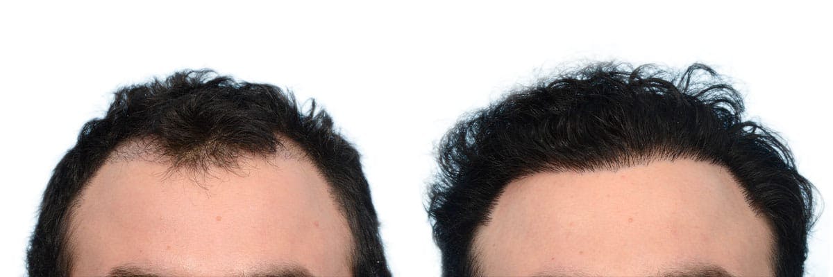 Hair Restoration Before & After Gallery - Patient 597599 - Image 1
