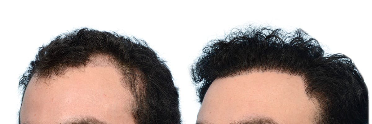 Hair Restoration Before & After Gallery - Patient 597599 - Image 2
