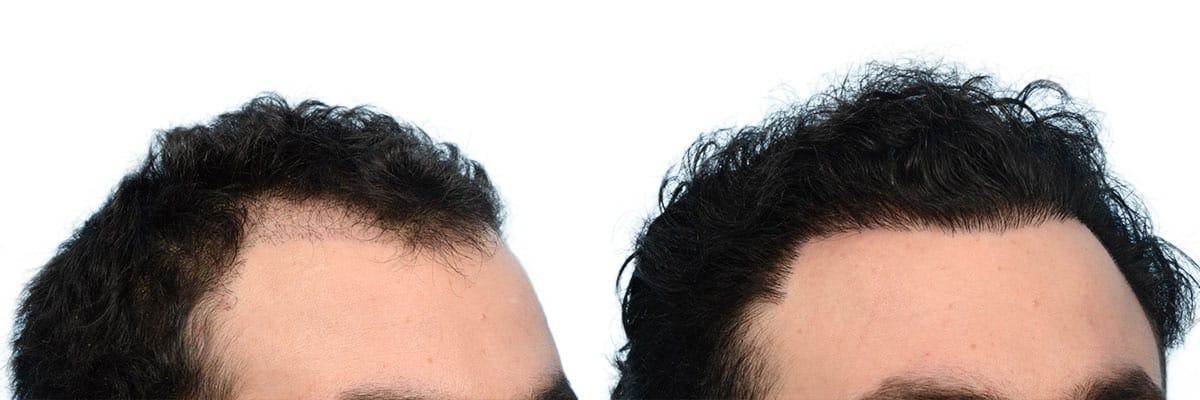 Hair Restoration Before & After Gallery - Patient 597599 - Image 3