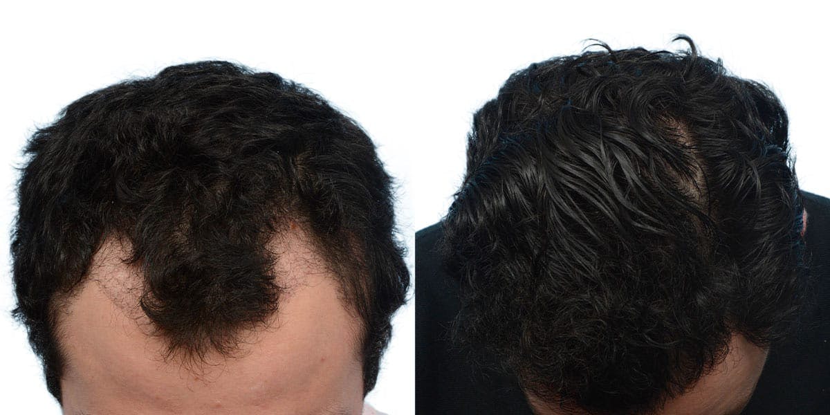 Hair Restoration Before & After Gallery - Patient 597599 - Image 4