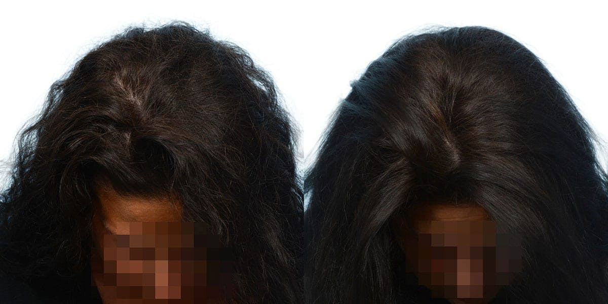 Hair Restoration Before & After Gallery - Patient 392065 - Image 2