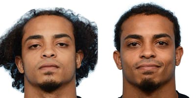 FUE Hair Transplant Before & After Gallery - Patient 369721 - Image 1
