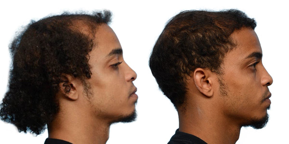 Hair Restoration Before & After Gallery - Patient 406352 - Image 3