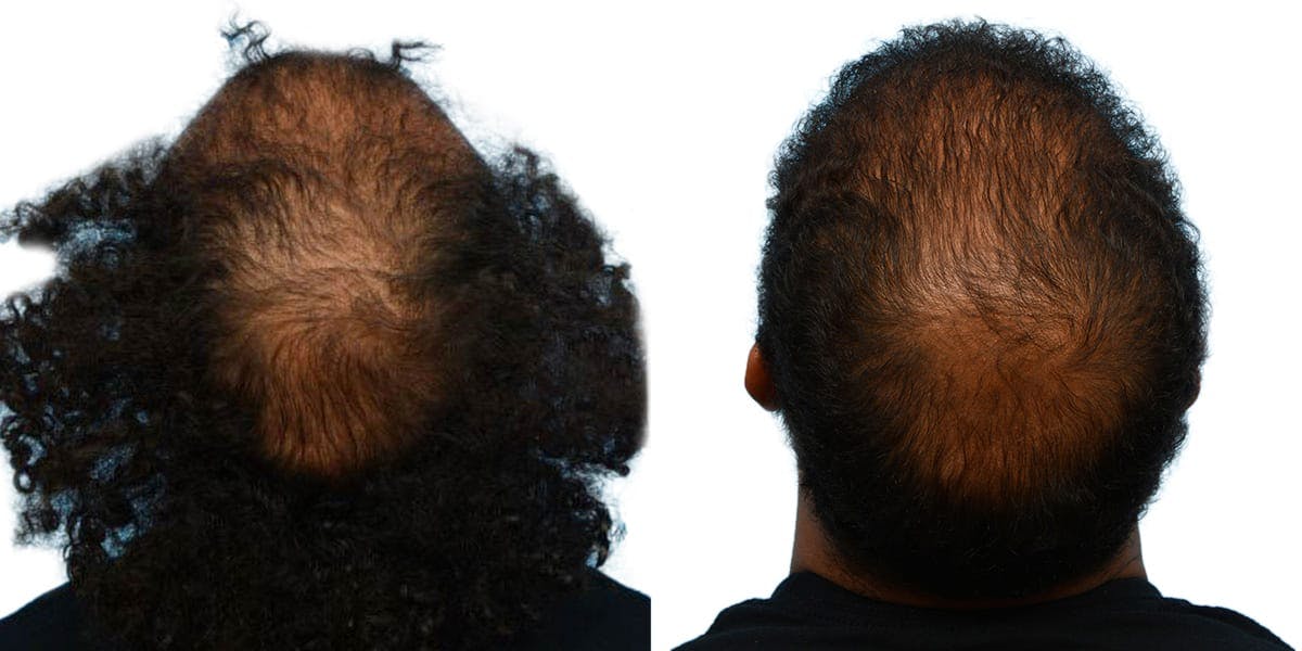 FUE Hair Transplant Before & After Gallery - Patient 369721 - Image 4