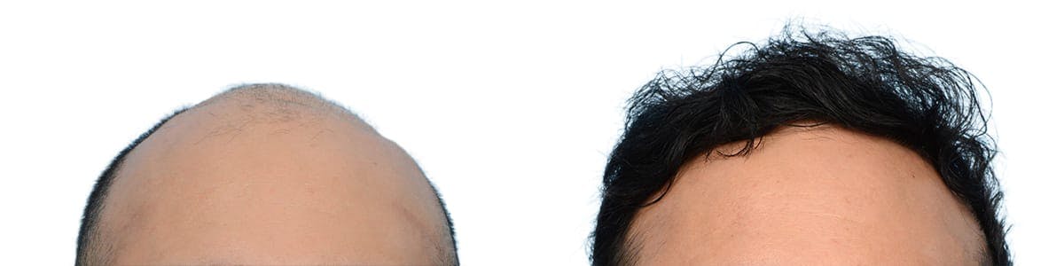 FUE Hair Transplant Before & After Gallery - Patient 737045 - Image 1