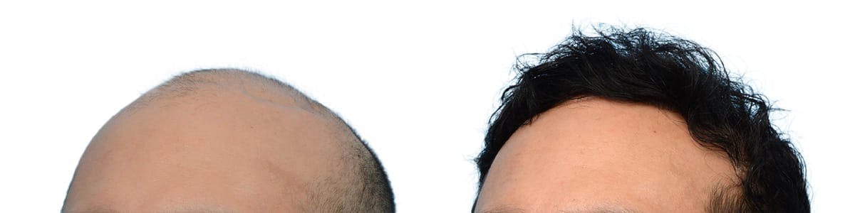 FUE Hair Transplant Before & After Gallery - Patient 737045 - Image 2